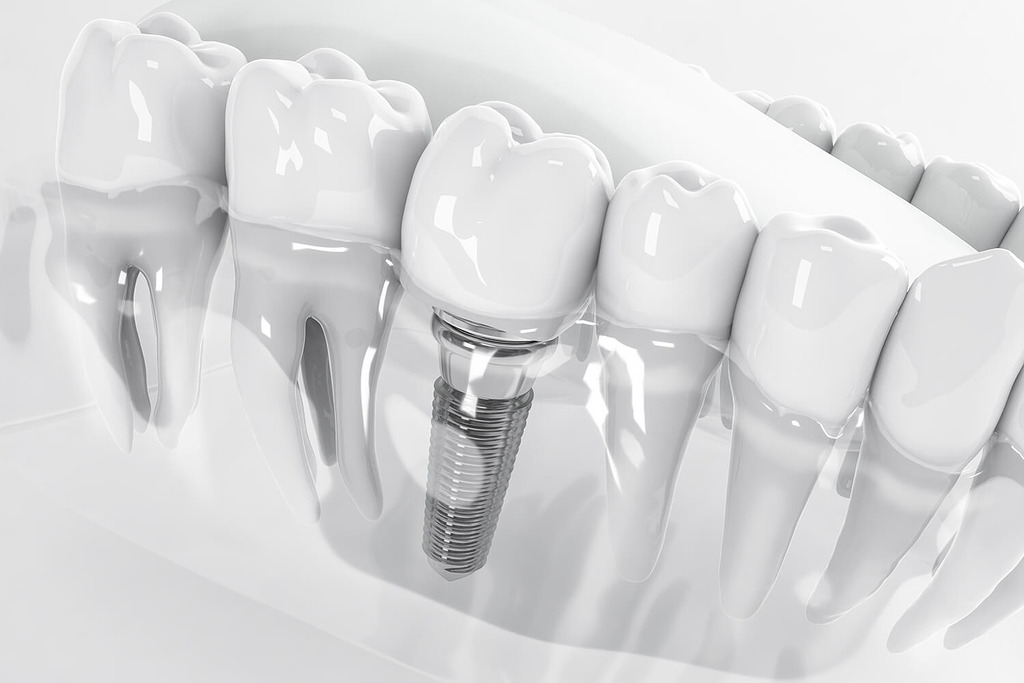 ảnh mô phỏng cắm trụ implant tại Nha khoa Cẩm Tú Nha khoa Quận 1