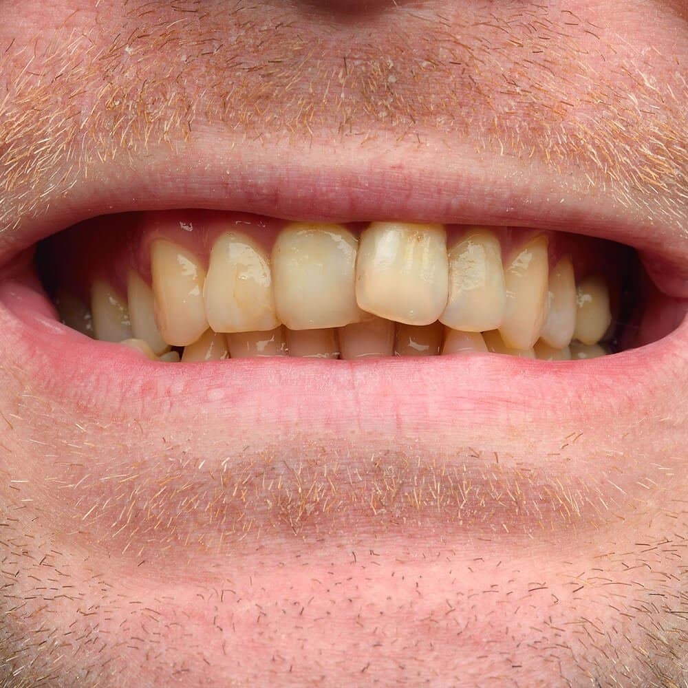 Ảnh răng bệnh nhân trước khi điều trị tại Nha khoa Cẩm Tú Nha khoa Quận 1 