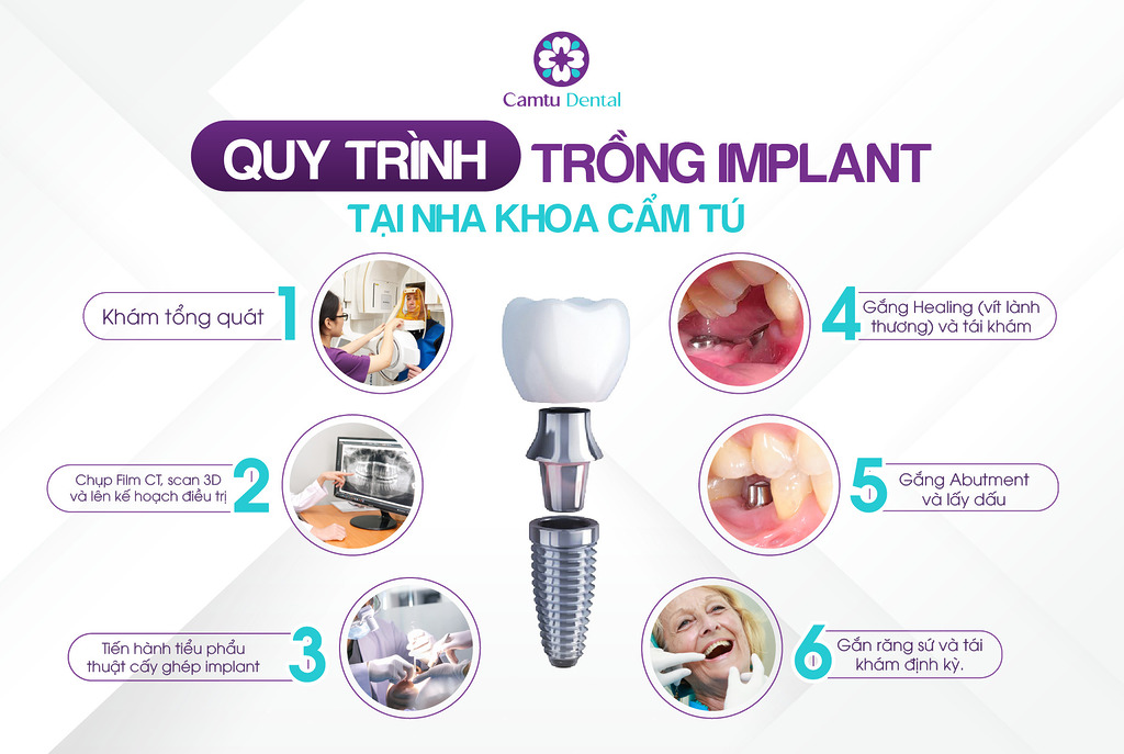 Quy trình trồng răng Implant tại Nha khoa Cẩm Tú Quận 1