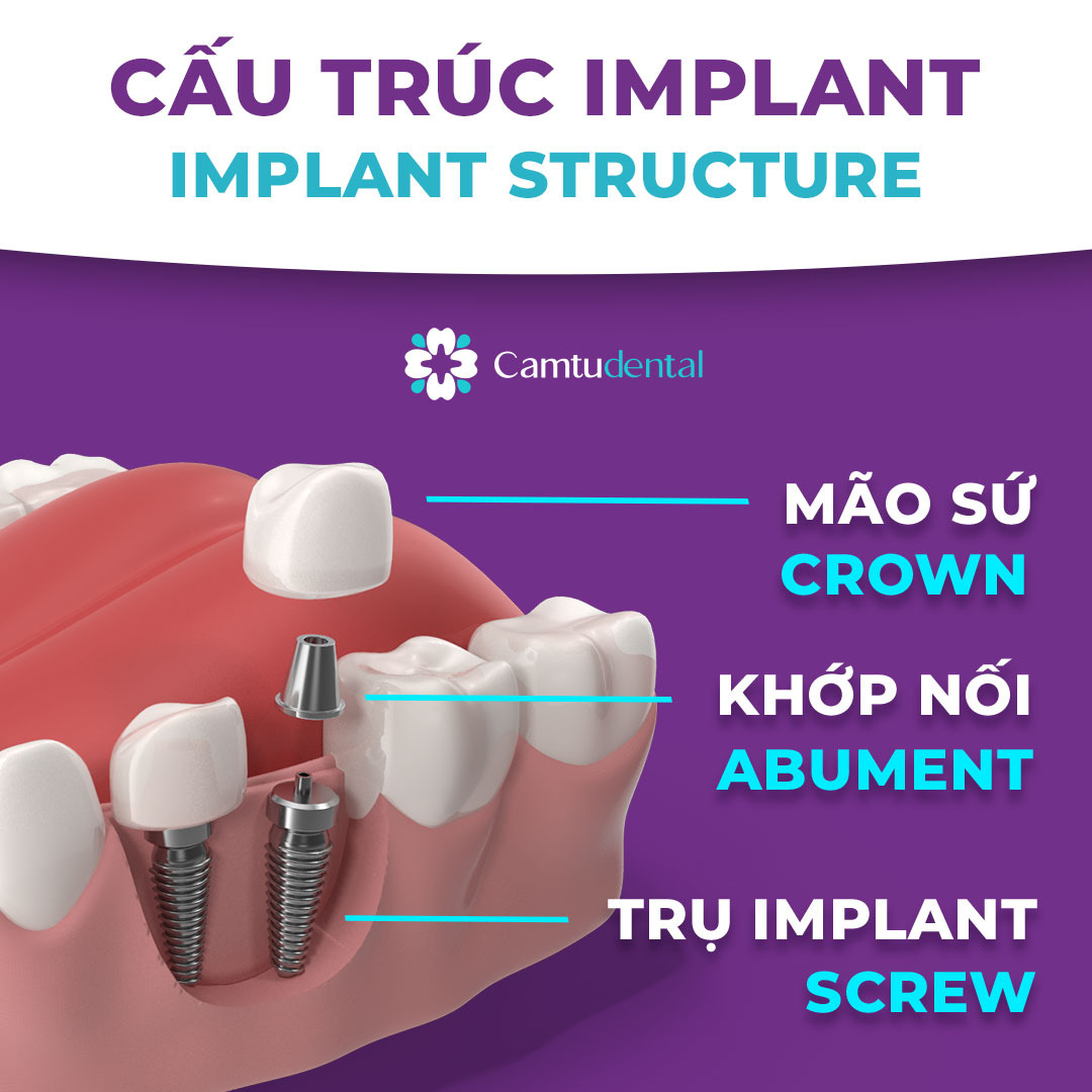 image 23 1 - Bảng giá Cấy ghép Implant. Chi phí trồng răng Implant là bao nhiêu? - Hệ thống Nha khoa Cẩm Tú