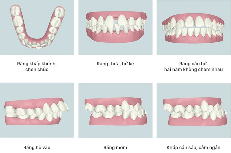 image 16 3 - Nên lựa chọn bọc răng sứ hay niềng răng? - Hệ thống Nha khoa Cẩm Tú
