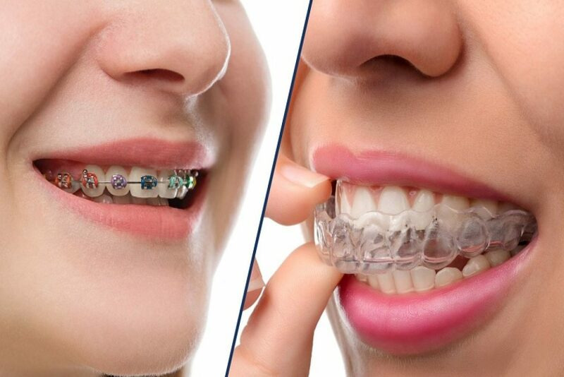 image 70 7 - Nên lựa chọn bọc răng sứ hay niềng răng? - Hệ thống Nha khoa Cẩm Tú