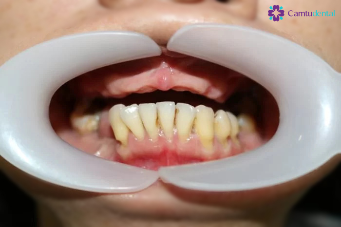hàm răng bị mất răng hàm trên