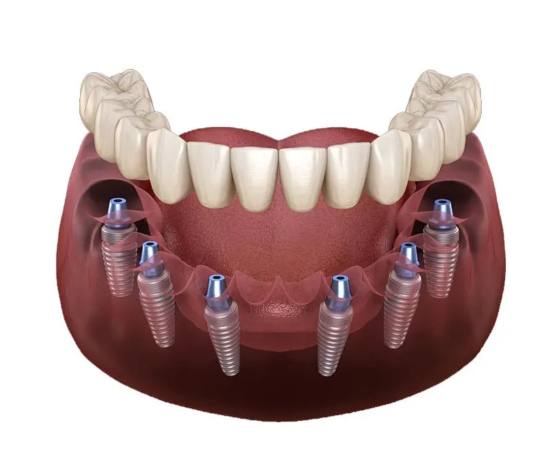 mô phỏng răng Implant All on 6