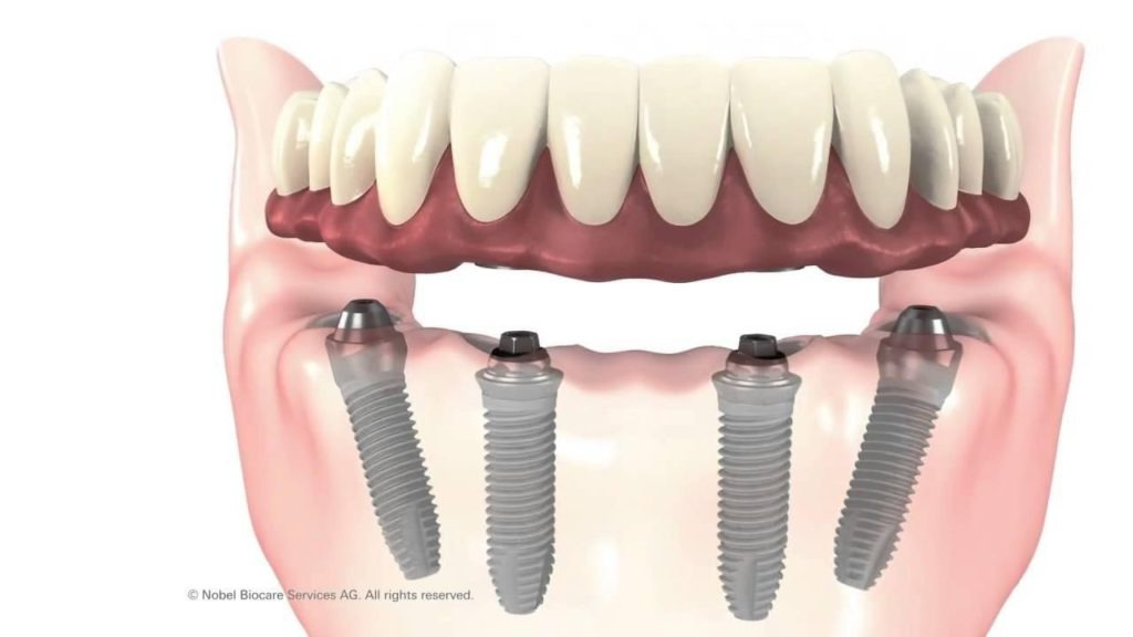 Mô phỏng răng Implant toàn hàm All on 4