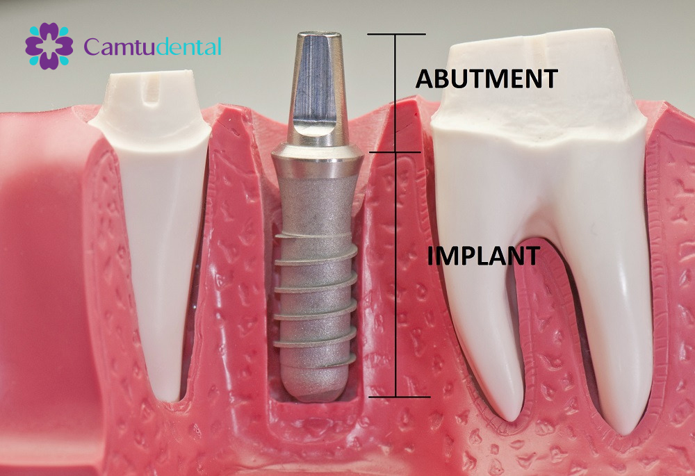 Abutment Implant la bo phan noi giua tru Implant va mao rang su - Quy trình trồng răng Implant tại Cẩm Tú - chi nhánh nha khoa Quận 1 - Hệ thống Nha khoa Cẩm Tú