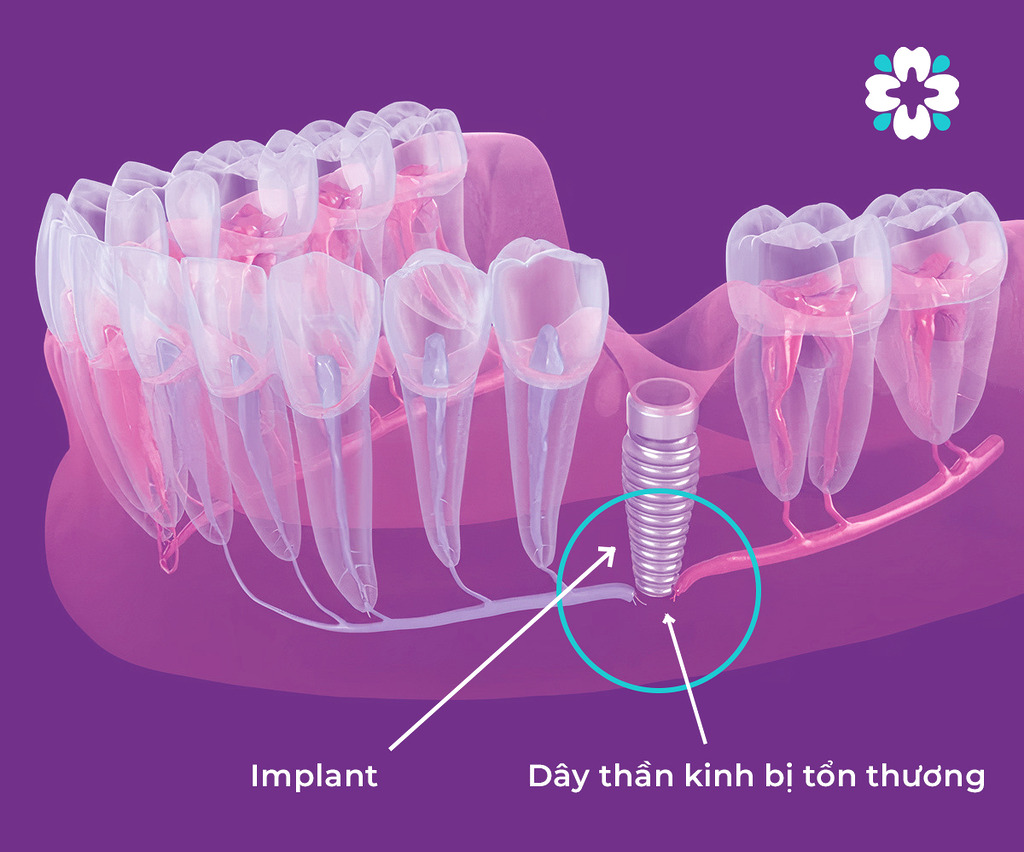 Cay ghep Implant sai dan den day than kinh bi ton thuong - Biến chứng của việc cấy ghép Implant thất bại - Hệ thống Nha khoa Cẩm Tú