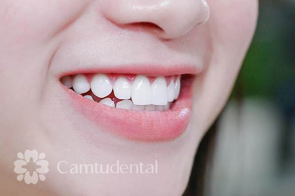 Loai rang su nay co do trong tu nhien - Răng sứ Zirconia là gì? Ưu và nhược điểm của răng sứ Zirconia - Hệ thống Nha khoa Cẩm Tú