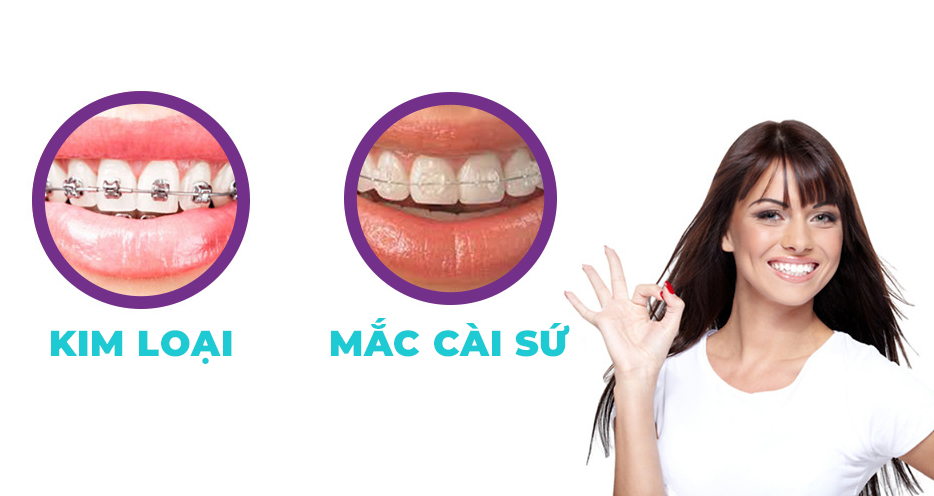 So sánh niềng răng mắc cài sứ và mắc cài kim loại tại Nha khoa Cẩm Tú Quận 1