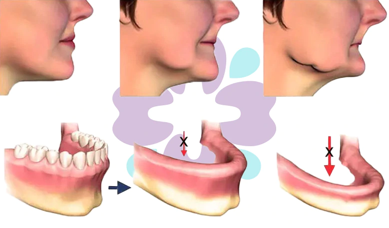Mách bạn 6 lợi ích của ghép Implant toàn hàm Hệ thống Nha khoa Cẩm Tú