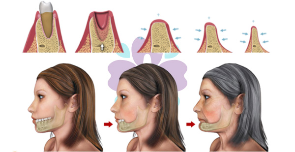 Minh họa quá trình tiêu xương ở hàm theo thời gian sau khi mất răng, với mặt cắt chi tiết về mật độ xương hàm