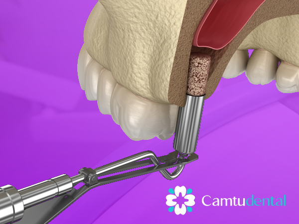 Nang xoang implant tai nha khoa cam tu quan 1 - 5 yếu tố quyết định thành công trong cấy ghép Implant - Hệ thống Nha khoa Cẩm Tú