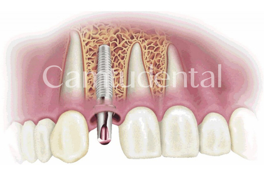 Mô phỏng trường hợp ghép Implant thất bại