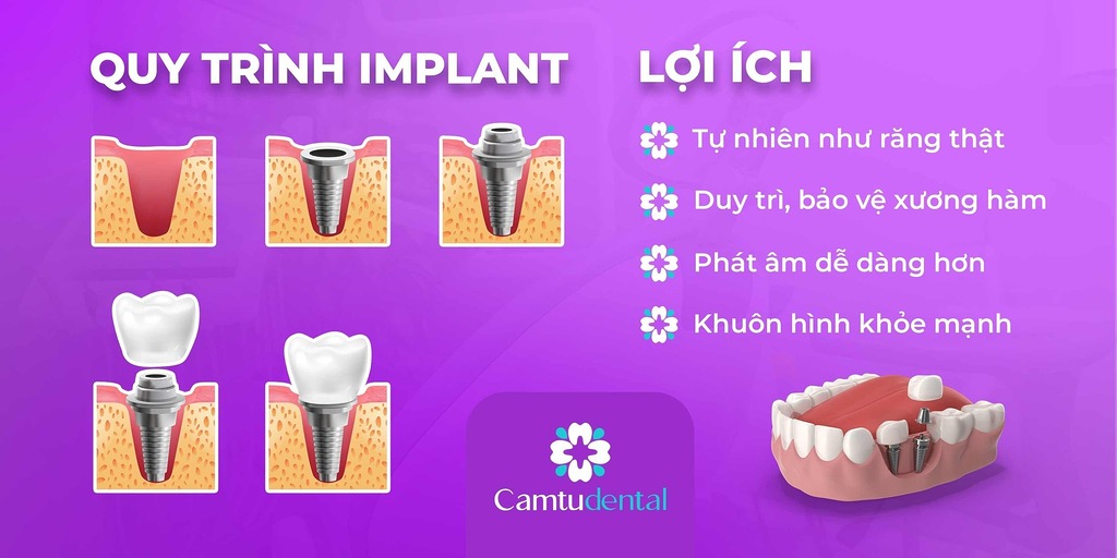 quy trinh implant va loi ich - 5 yếu tố quyết định thành công trong cấy ghép Implant - Hệ thống Nha khoa Cẩm Tú