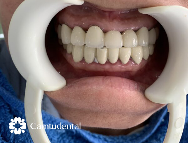 IMG 1026 600x800 1 - Vì sao răng bị ê buốt sau khi bọc sứ? Làm sao để khắc phục - Hệ thống Nha khoa Cẩm Tú