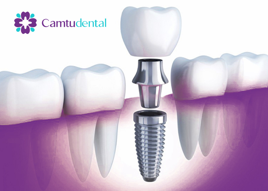 Quy trinh trong rang Implant co the keo dai tu 6 den 12 thang hoac hon - Ưu và nhược điểm khi trồng răng Implant - Hệ thống Nha khoa Cẩm Tú