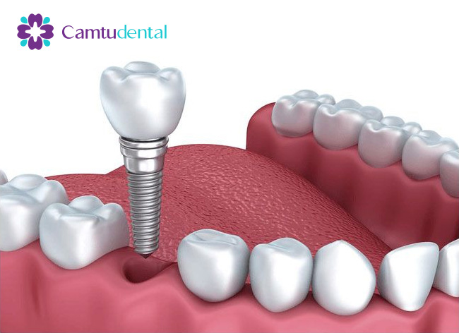Trong rang Implant khong can phai mai hay khoan cac rang ke can de lam tru nang do - Ưu và nhược điểm khi trồng răng Implant - Hệ thống Nha khoa Cẩm Tú