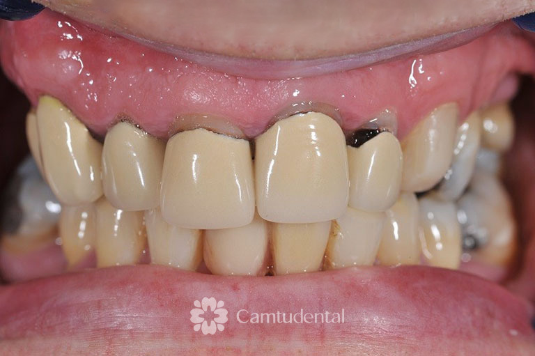 Viem loi do su dung rang su chat luong kem - 4 Nguyên nhân gây viêm lợi khi bọc răng sứ và cách khắc phục - Hệ thống Nha khoa Cẩm Tú