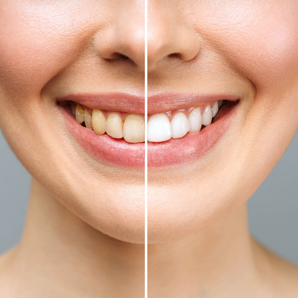 ẢNh so sánh giữa răng sau khi điều trị tại Nha khoa Cẩm Tú Nha khoa Quận 1 