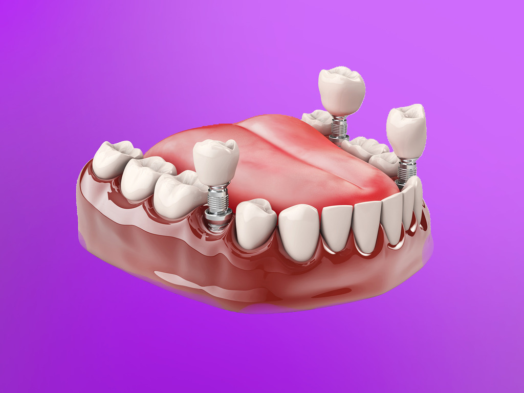 chat luong tru implant tai nha khoa cam tu quan 1 - Quy trình trồng răng Implant tại Cẩm Tú - chi nhánh nha khoa Quận 1 - Hệ thống Nha khoa Cẩm Tú