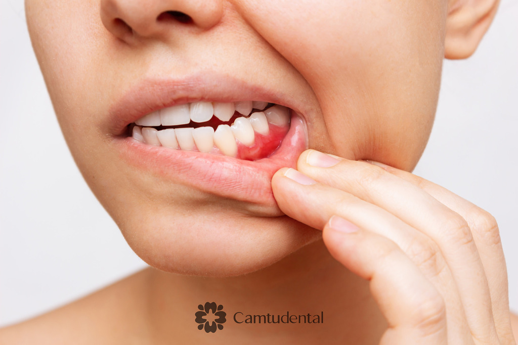 gum inflammation cropped shot young woman showing red bleeding gums - Hướng dẫn vệ sinh răng miệng sau khi bọc răng sứ để tăng tuổi thọ răng - Hệ thống Nha khoa Cẩm Tú