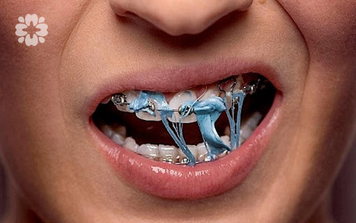 image 14 1 - So sánh niềng răng mắc cài kim loại và mắc cài sứ - Hệ thống Nha khoa Cẩm Tú