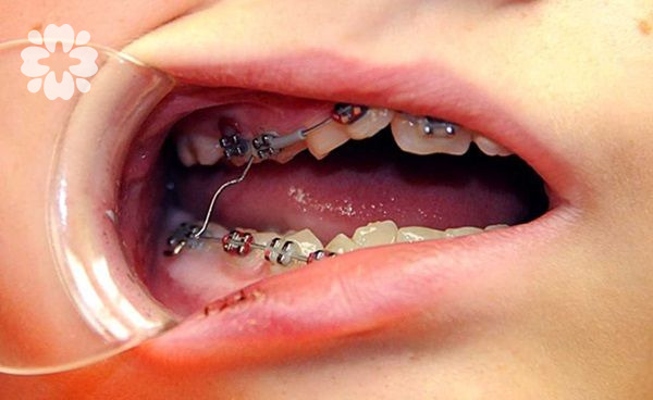 image 14 2 - So sánh niềng răng mắc cài kim loại và mắc cài sứ - Hệ thống Nha khoa Cẩm Tú