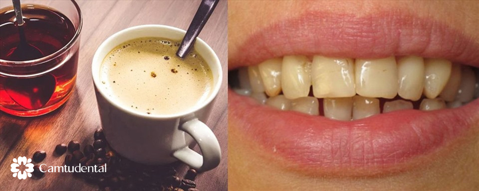 image 18 - Hướng dẫn vệ sinh răng miệng sau khi bọc răng sứ để tăng tuổi thọ răng - Hệ thống Nha khoa Cẩm Tú