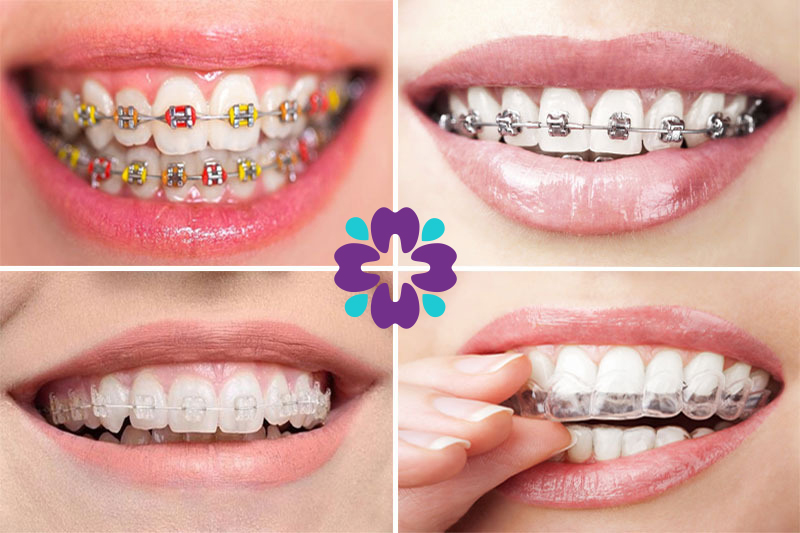 image 22 3 - Nên lựa chọn bọc răng sứ hay niềng răng? - Hệ thống Nha khoa Cẩm Tú