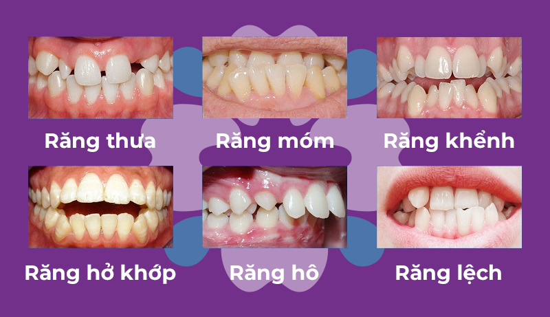 image 22 - Nên lựa chọn bọc răng sứ hay niềng răng? - Hệ thống Nha khoa Cẩm Tú