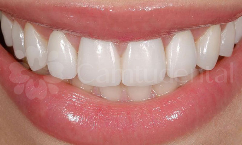image 70 6 - Nên lựa chọn bọc răng sứ hay niềng răng? - Hệ thống Nha khoa Cẩm Tú