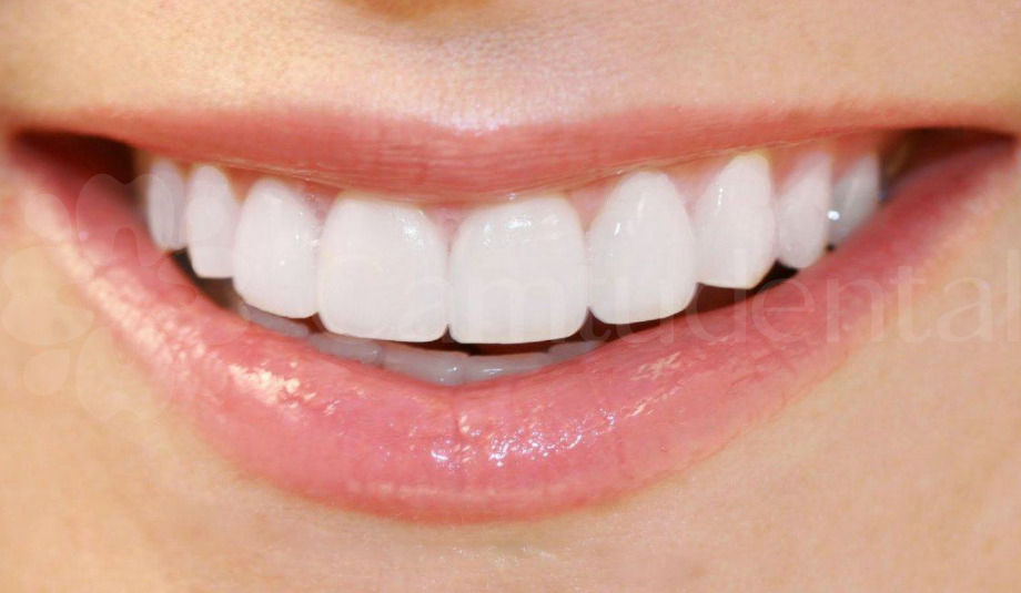 image 72 4 - Vì sao nên lựa chọn bọc răng sứ không kim loại tại Nha khoa Cẩm Tú? - Hệ thống Nha khoa Cẩm Tú