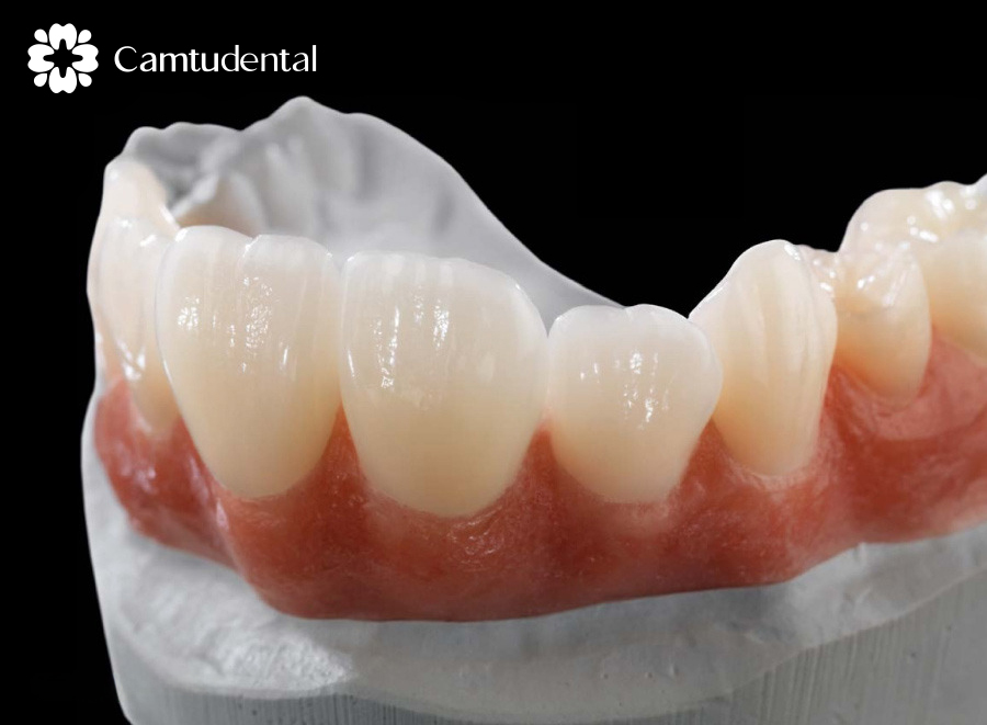 image 72 - Vì sao nên lựa chọn bọc răng sứ không kim loại tại Nha khoa Cẩm Tú? - Hệ thống Nha khoa Cẩm Tú