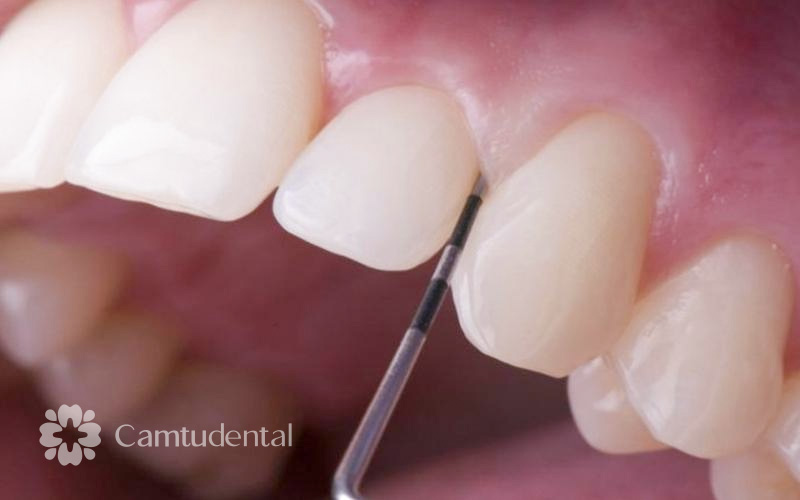 viem loi do rang su xam pham khoang sinh hoc - 4 Nguyên nhân gây viêm lợi khi bọc răng sứ và cách khắc phục - Hệ thống Nha khoa Cẩm Tú