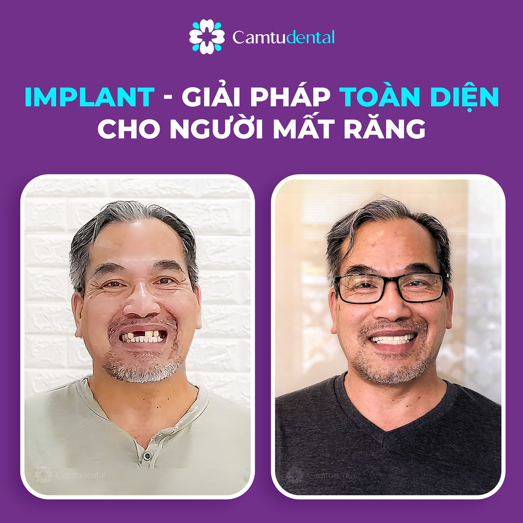 ghep implant giai phap toan dien cho nguoi mat rang - Bạn có biết cách phân biệt Implant toàn hàm All on 4 và All on 6? - Hệ thống Nha khoa Cẩm Tú