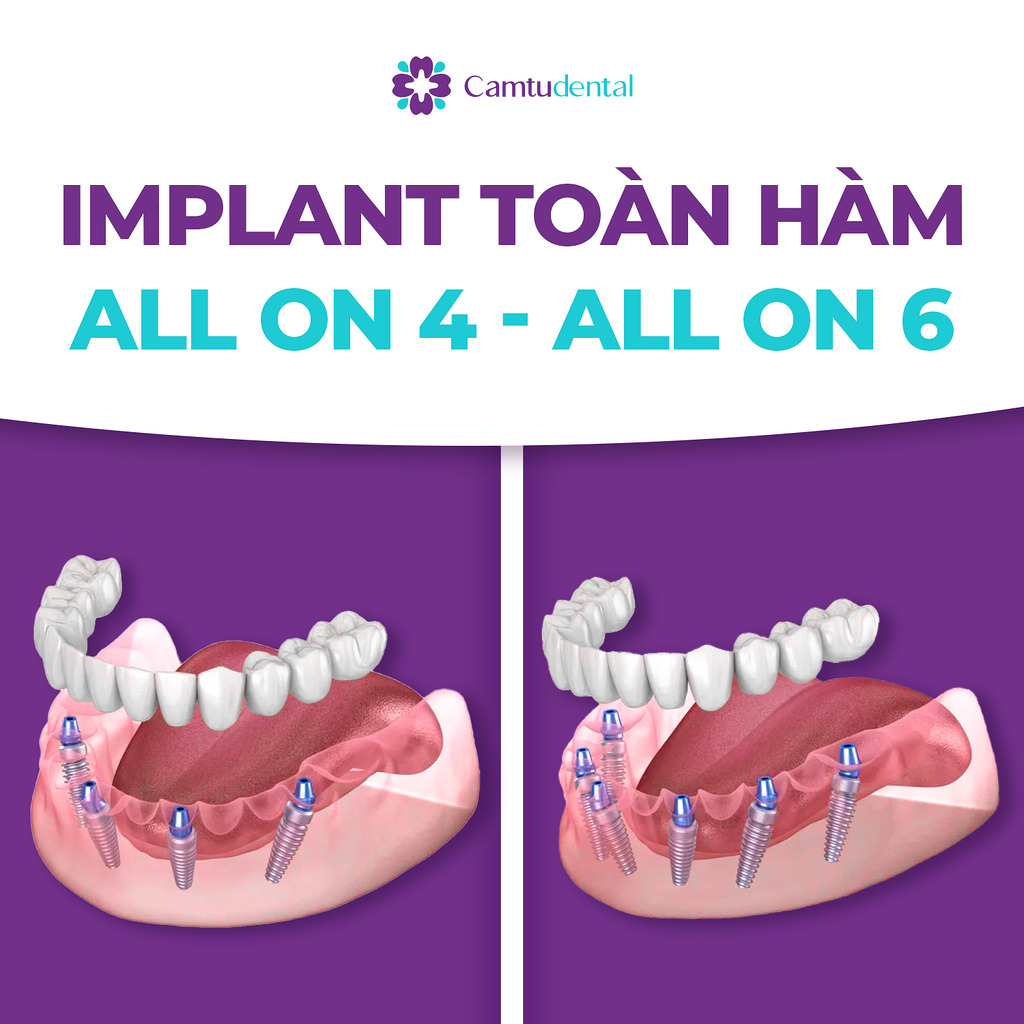 implant all on 4 all on 6 - Bạn có biết cách phân biệt Implant toàn hàm All on 4 và All on 6? - Hệ thống Nha khoa Cẩm Tú