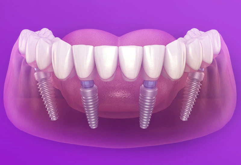 image 1 - Bảng giá Cấy ghép Implant. Chi phí trồng răng Implant là bao nhiêu? - Hệ thống Nha khoa Cẩm Tú