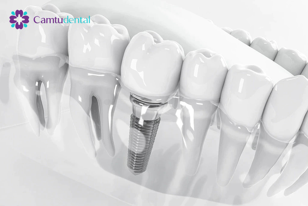Hình minh họa 3D của trụ implant trong xương hàm do Nha khoa Camtu cung cấp, thể hiện sự tích hợp giữa implant và mão răng với răng tự nhiên.