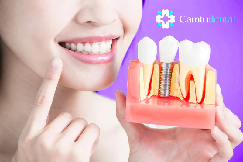 Người phụ nữ mỉm cười với hàm răng khỏe mạnh cầm mô hình cấy ghép Camtu Dental, thể hiện cấu trúc bên trong nướu khi cấy ghép Implant