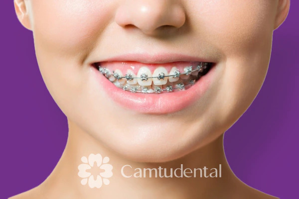 Cận cảnh nụ cười rạng rỡ, vui tươi với niềng răng kim loại truyền thống, thể hiện phương pháp điều trị chỉnh nha của Nha khoa Camtu.”