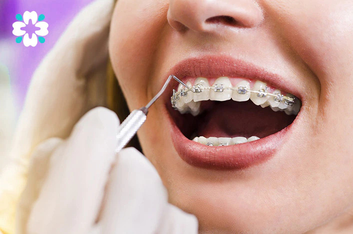 Cận cảnh quá trình điều chỉnh răng đang được thực hiện trên mắc cài sứ của bệnh nhân, nêu bật quá trình chăm sóc chỉnh nha chính xác và cẩn thận tại Nha khoa Cẩm Tú Quận 1