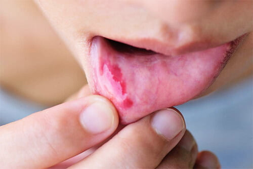Một người bộc lộ vết loét bên trong môi dưới, một vấn đề sức khỏe răng miệng thường gặp