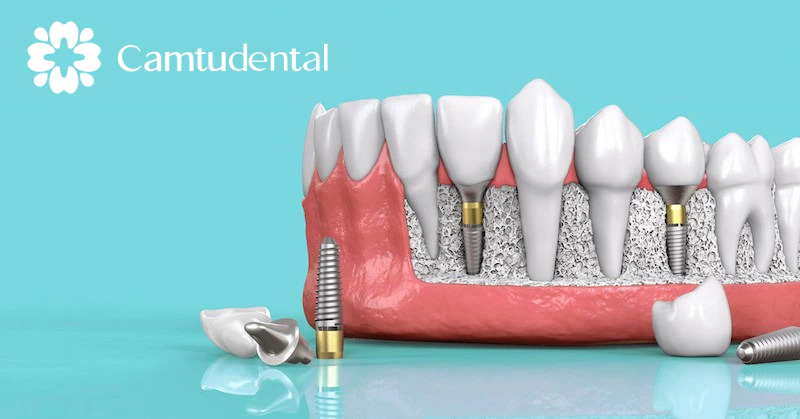 Hình minh họa chi tiết của Camtu Dental thể hiện quá trình cấy ghép nha khoa tập trung vào trụ cấy ghép, trụ cầu và mão răng liên quan đến xương hàm và đường viền nướu.