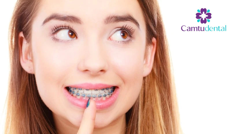 Người phụ nữ trẻ với vẻ mặt ngạc nhiên niềng răng có đau không và chỉ vào niềng răng kim loại màu xanh