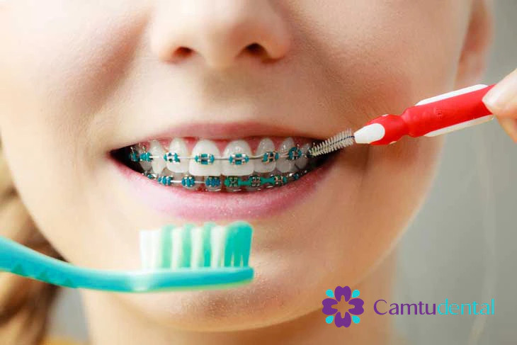 Cận cảnh một người đang làm sạch niềng răng kim loại bằng bàn chải kẽ răng và bàn chải đánh răng, minh họa các biện pháp vệ sinh răng miệng đúng cách do Camtu Dental khuyến nghị.