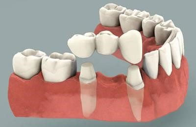 Mô hình 3D của cầu răng được sử dụng để thay thế các răng bị mất, minh họa cách các răng liền kề được chuẩn bị để neo giữ phục hình.