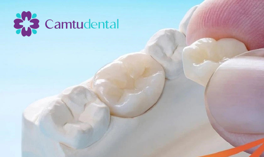 Cận cảnh quy trình bọc răng sứ của Camtu Dental, thể hiện độ chính xác và sự cẩn thận trong phục hình răng."