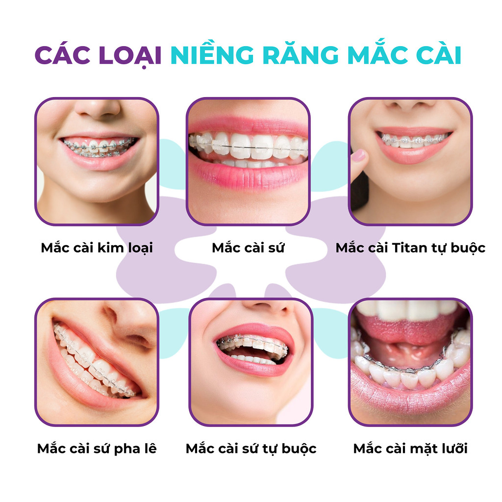 Các loại mắc cài niềng răng bao gồm kim loại, sứ, titan tự buộc, sứ pha lê, sứ tự buộc, mặt lưỡi