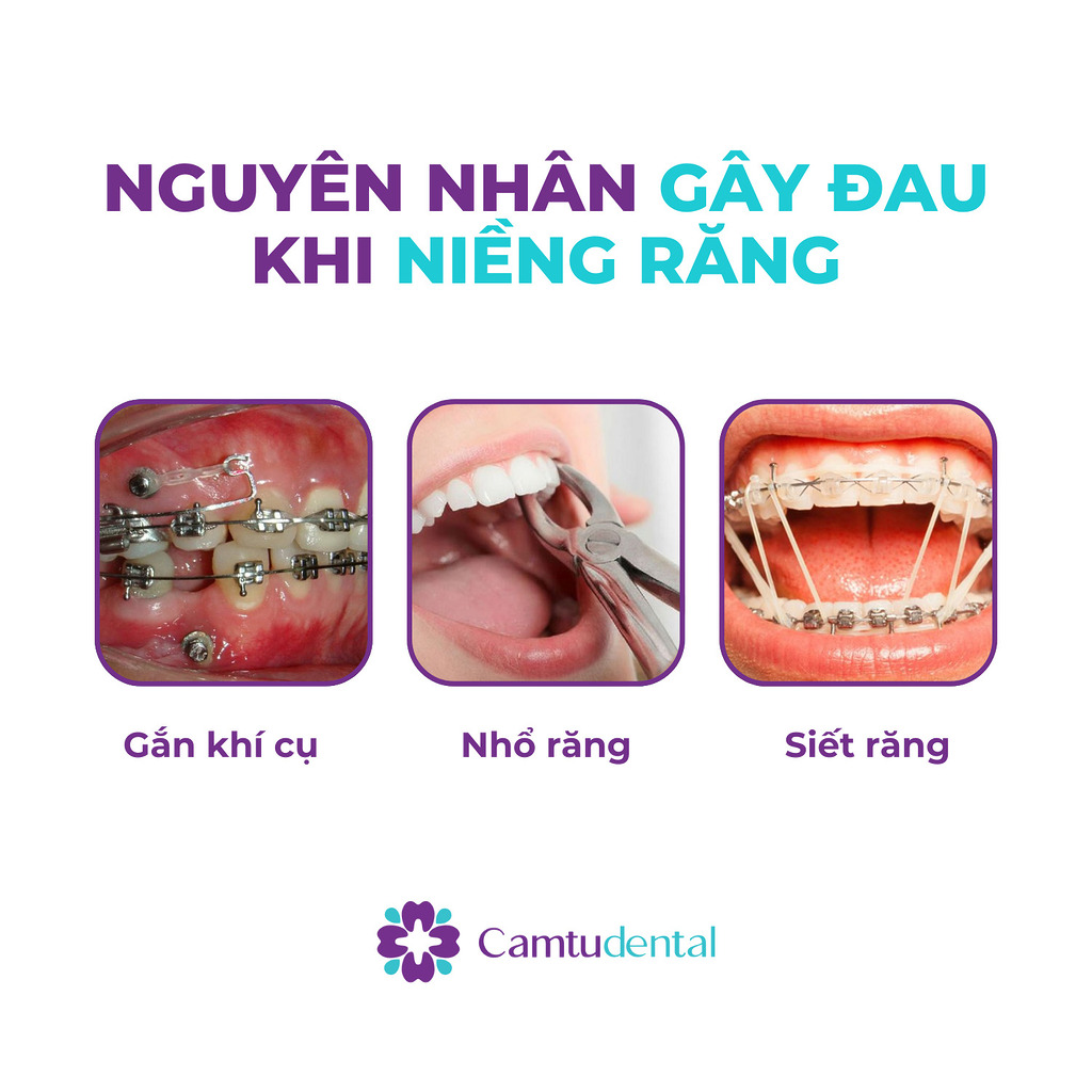 Nguyên nhân gây đau khi niềng răng bao gồm gắn khí cụ, nhổ răng, siết răng