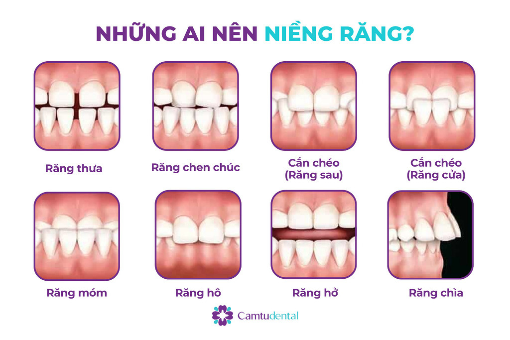 Hình ảnh mô tả những trường hợp nên niềng răng như ranwgthuwa, răng chen chúc, cắn chéo, răng móm, hô, răng hở, răng chìa